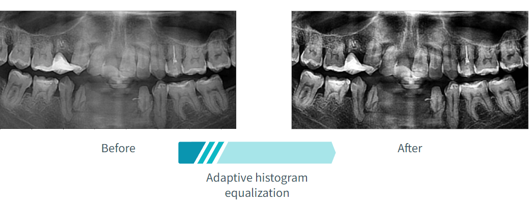 Preprocessed X-Ray